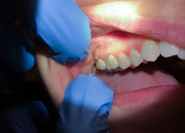 Best Emergency Treatment for Dental Infections or Abscesses in Taylorsville, NC